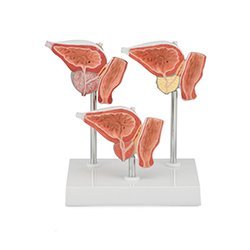 Normal And Diseased Prostate Gland